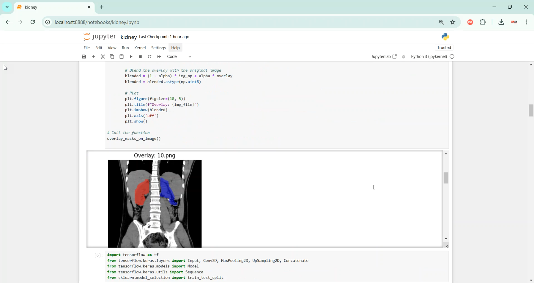 Kidney Tumor Segmentation in Python Projects