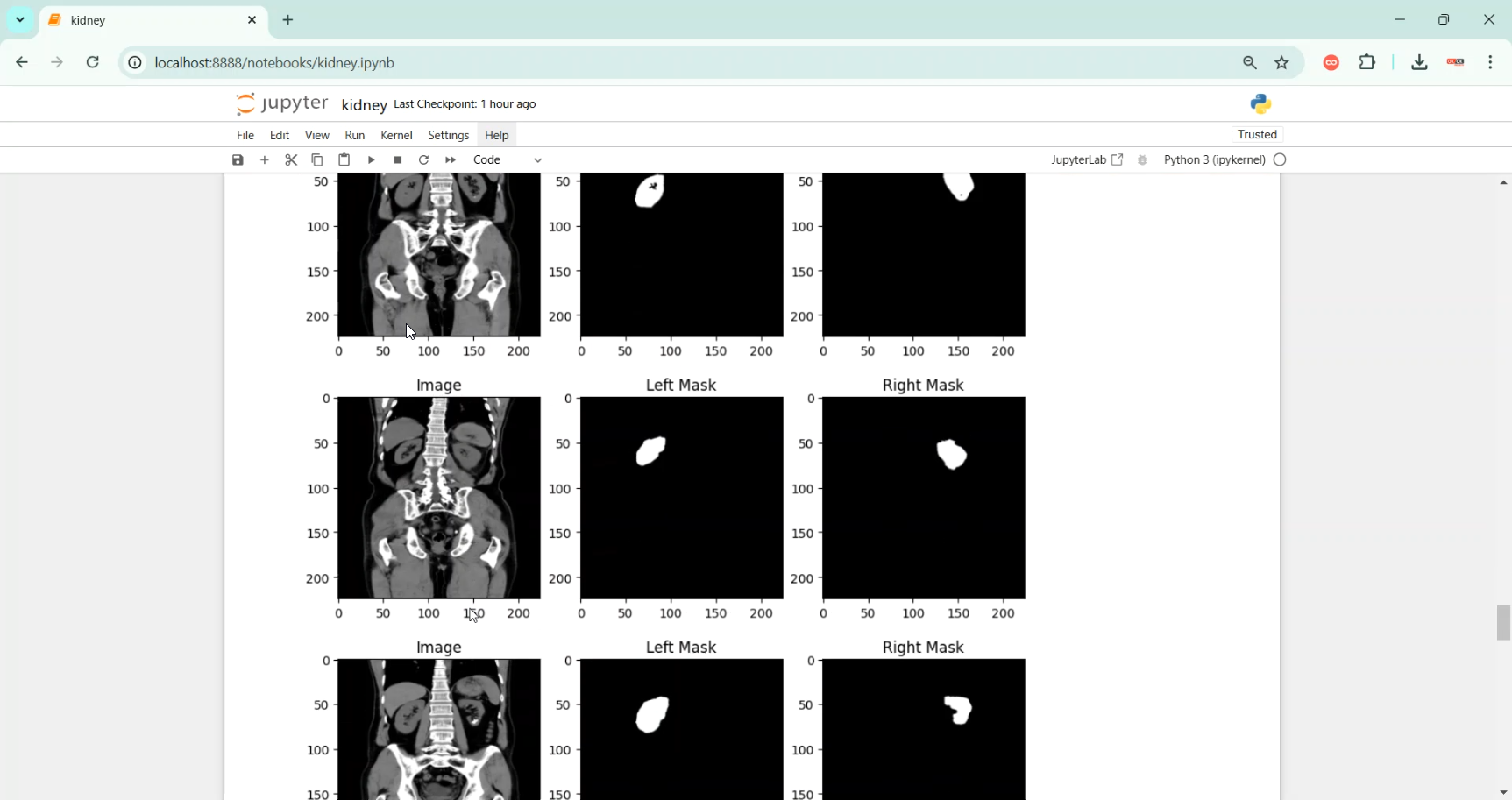Kidney Tumor Segmentation in Python Projects